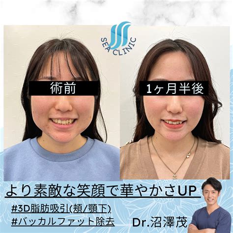 ひと回り小さい輪郭へ Sea Clinic −シークリニック 銀座― 理想を叶える小顔治療