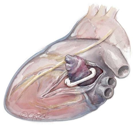 AtriClip Left Atrial Appendage Closure - Gold Coast