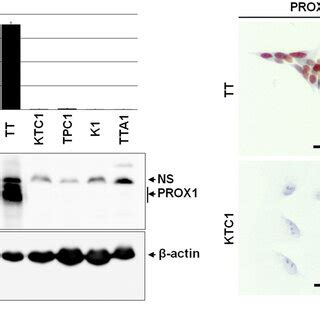 Expression Of PROX1 In Normal Thyroid And Thyroid Cancer Tissues Left