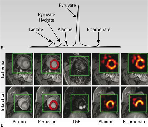 Metabolic Imaging Of The Human Heart Clinical Application Of Magnetic