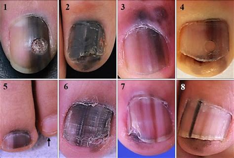 Sinal De Hutchinson Melanoma Braincp