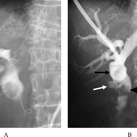 A Initial Percutaneous Transhepatic Cholangiogram Shows A Common