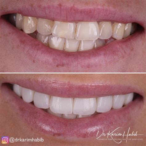 Composite Veneers Sydney Dental Bonding Sydney Dentist Ryde