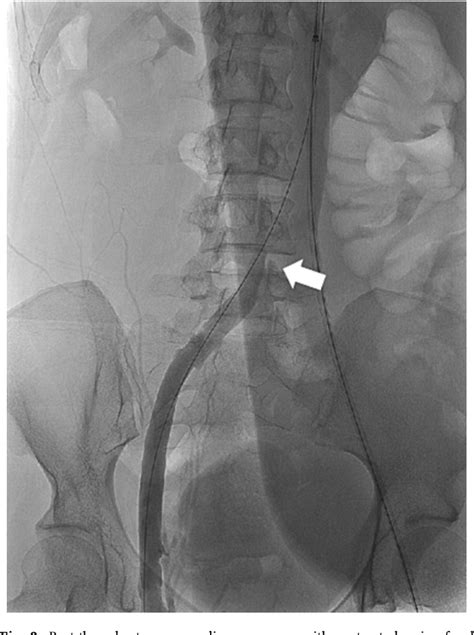 Figure From Endovascular Resolution Of Complete Common Iliac Vein