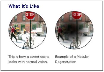 Drusen, Macular Degeneration, what it is and prevention! | Holistic ...