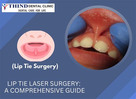 Lip Tie Laser Surgery: A Comprehensive Guide