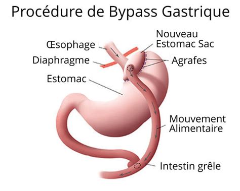 Bypass Gastrique Madrid Institut Jesus Lago