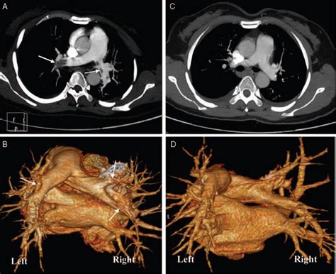 CT Pulmonary Angiography CTPA In Case 1 CTPA With 2 Dimensional