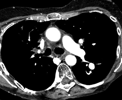 Pulmonary Artery Aneurysms And Pseudoaneurysms In Adults Findings At