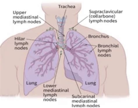 Lung Cancer Flashcards Quizlet