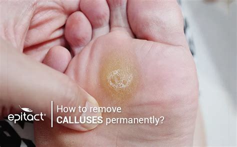 Callus Removal From Feet A Young Yoga Instructor The Foot 54 Off