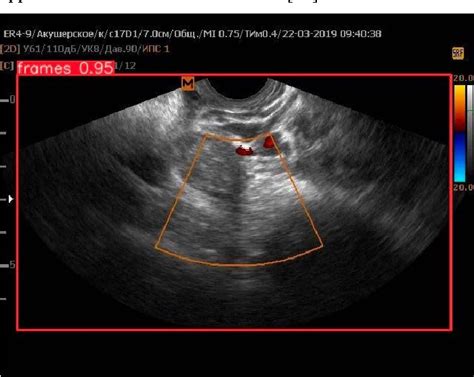 Figure 1 From Computer Vision Methods For Assessing Ovarian Reserve