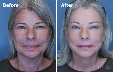 Face And Neck Lift Index Dr Schalit Cosmetic Facial Specialist