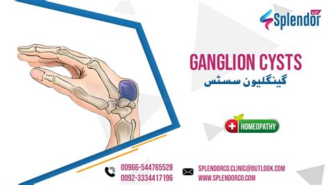 Homeopathic Medicines For Ganglion Cysts