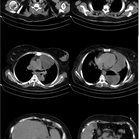 Clinical Evaluations Of Abdomen After Diaphragmatic Hernia Surgery