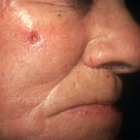 Photograph Rodent Ulcer On Patient S Cheek Science Source Images