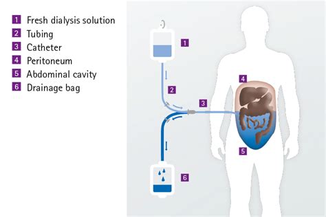 Peritoneal dialysis