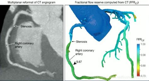 医学知识 Ffr（冠状动脉血流储备分数） Csdn博客