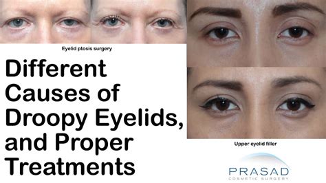 What Causes A Droopy Eye? | Dr. Amiya Prasad Blog