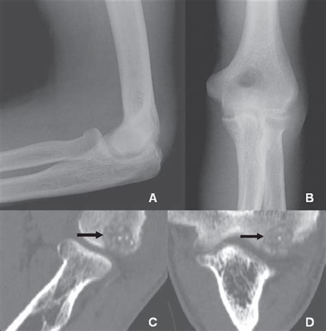 Caso A B Radiografias Nas Incid Ncias Lateral E Anteroposterior Do