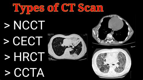 Hrct Scan