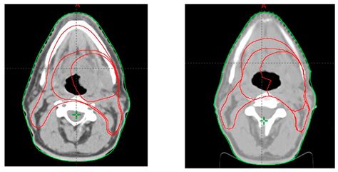 Jpm Free Full Text Adaptive Radiotherapy In Head And Neck Cancer Using Volumetric Modulated