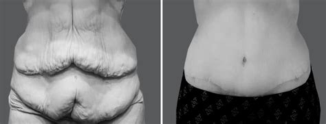 Gastric Bypass Skin