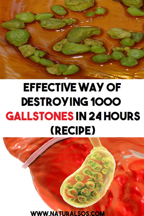 Effective Way Of Destroying 1000 Gallstones In 24 Hours Recipe