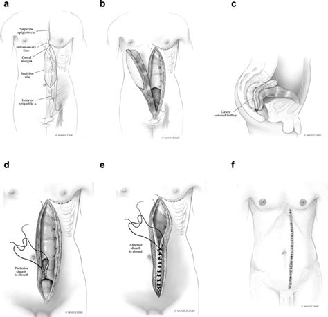 Vertical Rectus Abdominis Muscle Vram Flap Design With Its Vascular