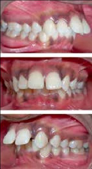 Showing Angles Class Ii Division 1 Malocclusion With Large Overjet And Download Scientific