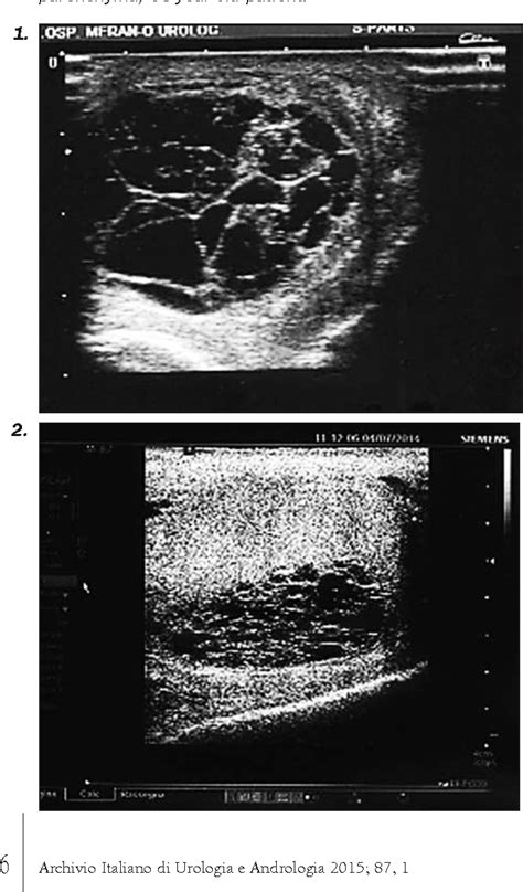 Mediastinum Testis Ultrasound