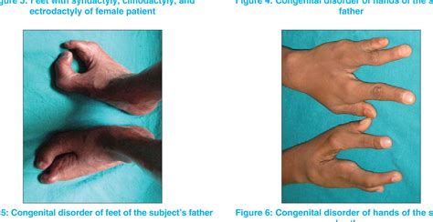 Figure 7 From Association Of Generalized Aggressive Periodontitis And