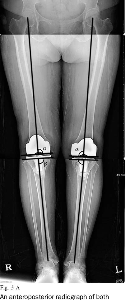 Figure 3 From Range Of Motion Of Standard And High Flexion Posterior