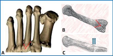 Osteotom As En Pie Cavo Varo Fondoscience