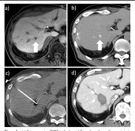 Figure From Radiofrequency Ablation Combined With Hepatic Artery