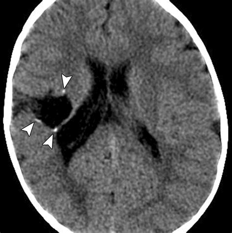 Differential Diagnosis Of Intracranial Cystic Lesions At Head Us