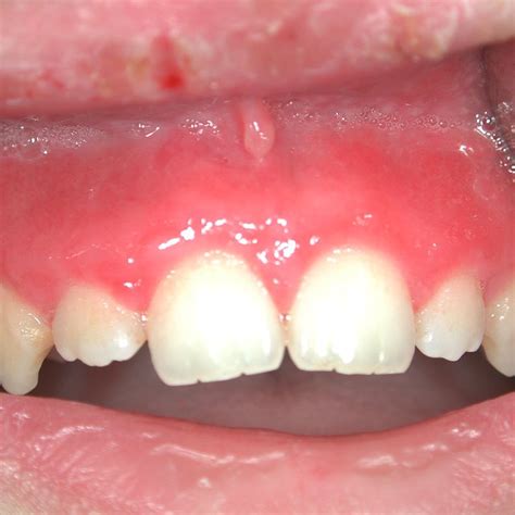 Pdf Cheilitis And Gingivitis As First Signs Of Crohns Disease In A