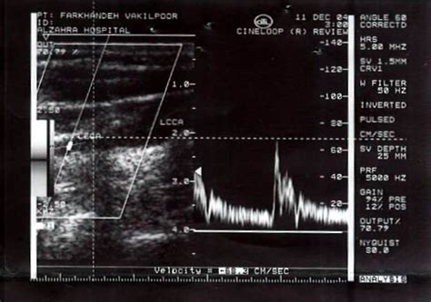 Normal Flow Pattern In Left Common Carotid Artery Lcca And Left Download Scientific Diagram