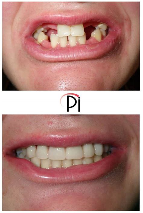 Congenitally Missing Teeth