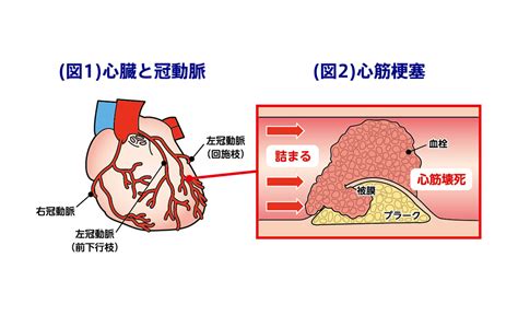 【第1回】正しい運動療法で心筋梗塞・心不全のリスクを減らそう～心筋梗塞の基本と主な症状～ リガクラボ あなたの毎日に笑顔をプラスする