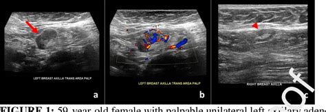 Figure 1 from Unilateral axillary Adenopathy in the setting of COVID-19 ...