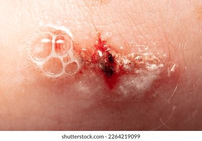 Wound On Human Skin Hydrogen Peroxide Stock Photo 2264219099 Shutterstock