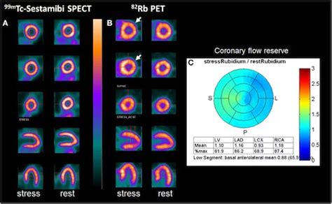 nuclear stress test results - Manhattan Cardiology