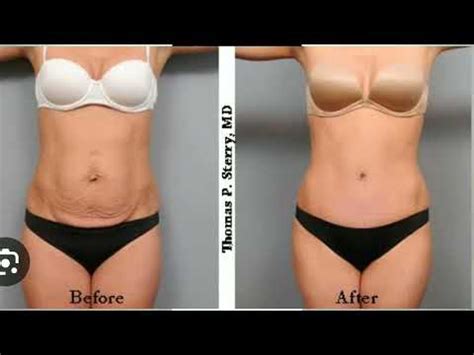 Tummy Tuck How Does Tummy Tuck Surgery Really Works Hidden Secrets You