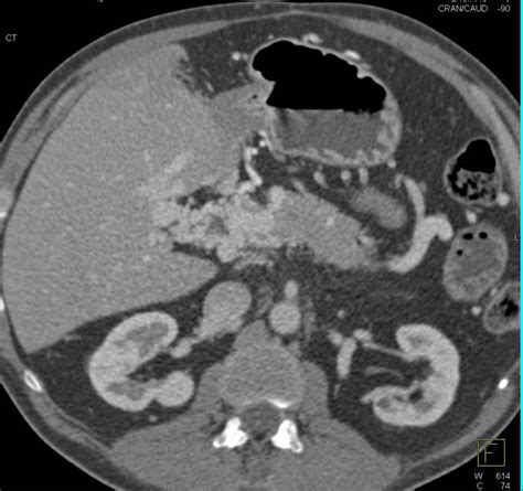 Carcinoid Tumor With Desmoplastic Reaction Of Mesentery With Tethered