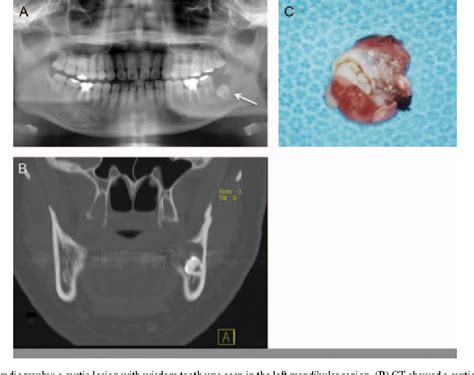 Figure 1 From Unicystic Ameloblastoma Metastasizing To Multiple