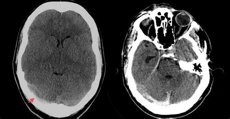 Cerebral Venous Thrombosis A Rapid Review First10em