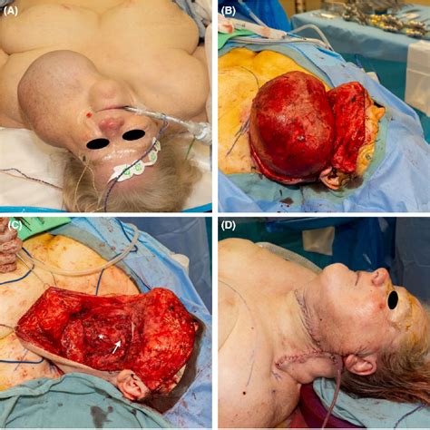 Figure 2 From Excision Of Massive Left Branchial Cleft Cyst With Secondary Hypertension