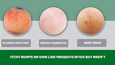 Guide: Itchy Bumps on Skin Like Mosquito Bites But Aren't