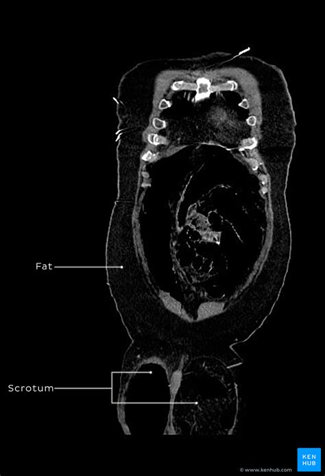 Giant Inguinal Hernia Clinical Case Anatomy Causes Kenhub Images And